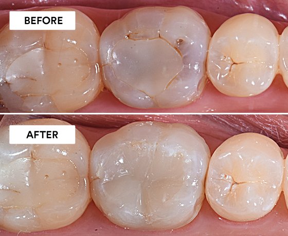 Informative oral care related imagery with a file name of relyx-application-850x550-1.png shown on Solventum's "Brain Floss" blog