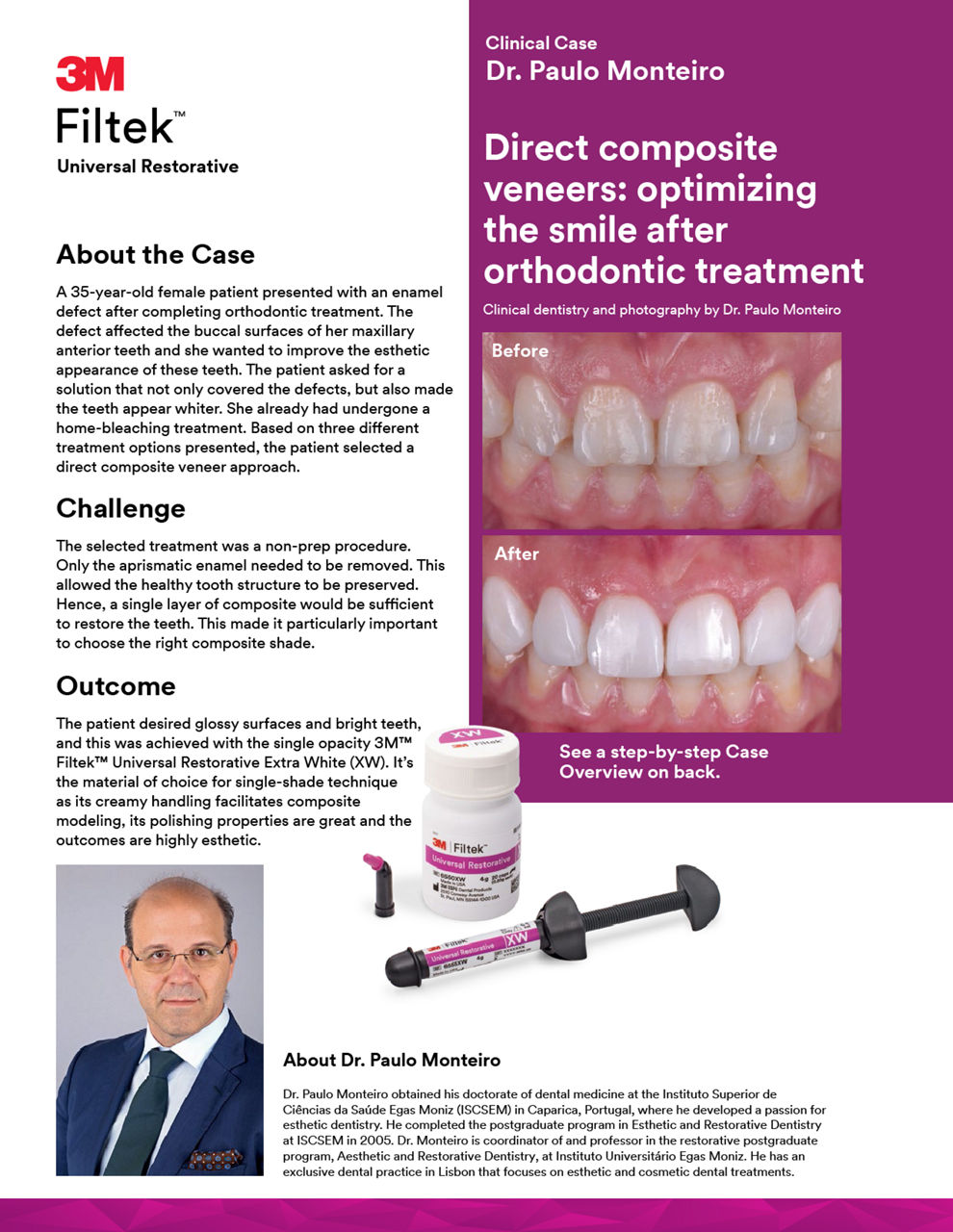 Filtek™ Universal Restorative Direct Anterior Veneers Clinical Case
