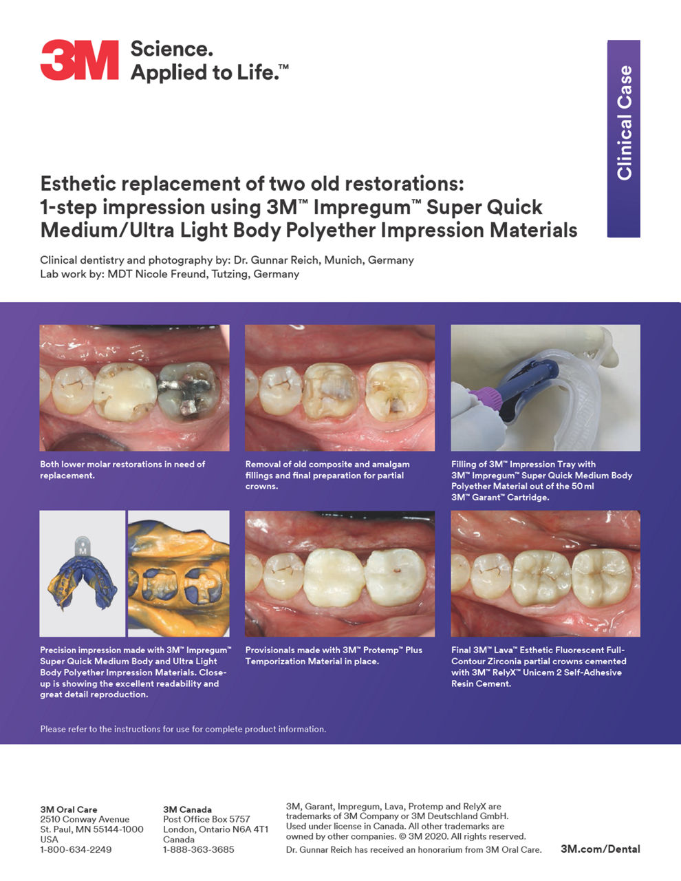 3M™ Impregum™ Penta™ Super Quick Clinical Case "Esthetic replacement of two old restorations"