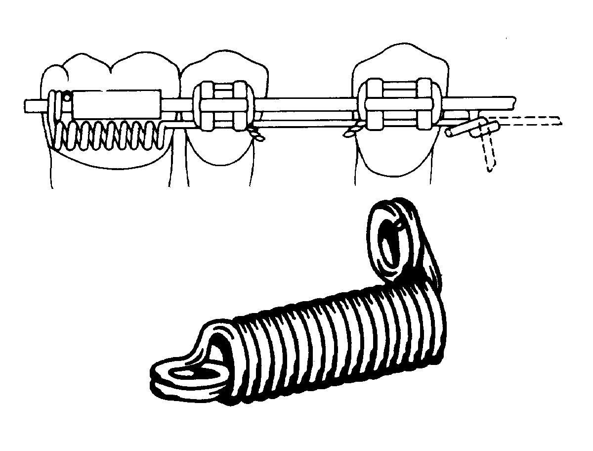 3M Unitek T Spring for Ligature Wire Attachment