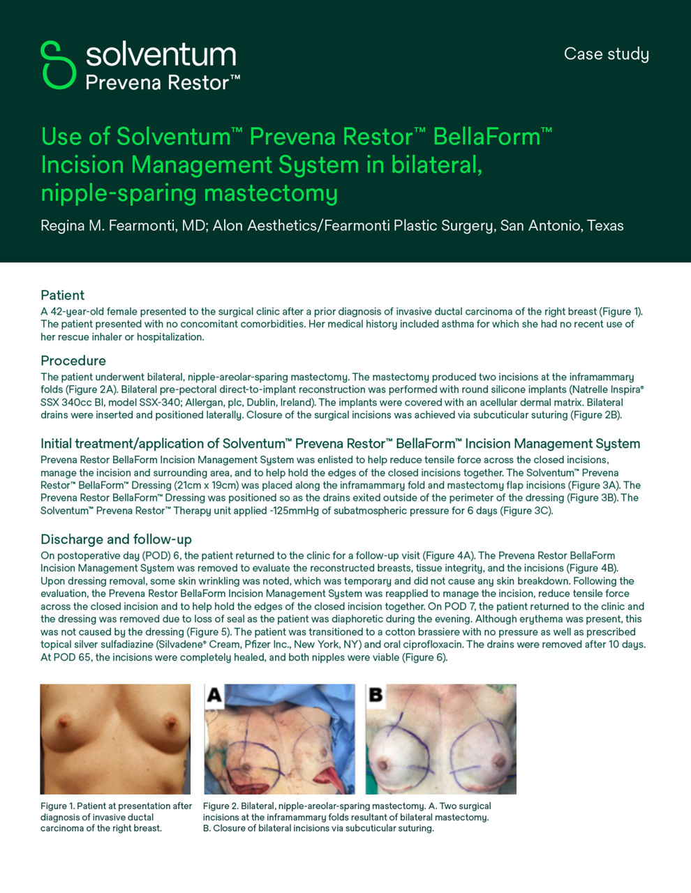 Prevena Restor BellaForm incision management system for mastectomy case study cover preview