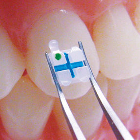 3M Clarity Advanced Ceramic Bracket placement