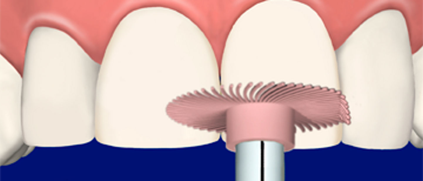 Illustration of Veneer Matrix Finishing with Sof-Lex Spiral Wheel