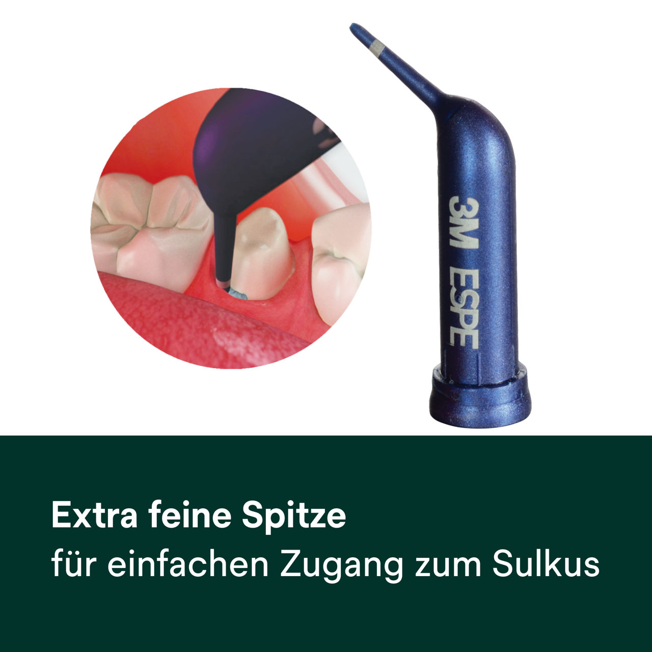 (2) Astringierende Retraktionspaste: Extra-feine Spitze
