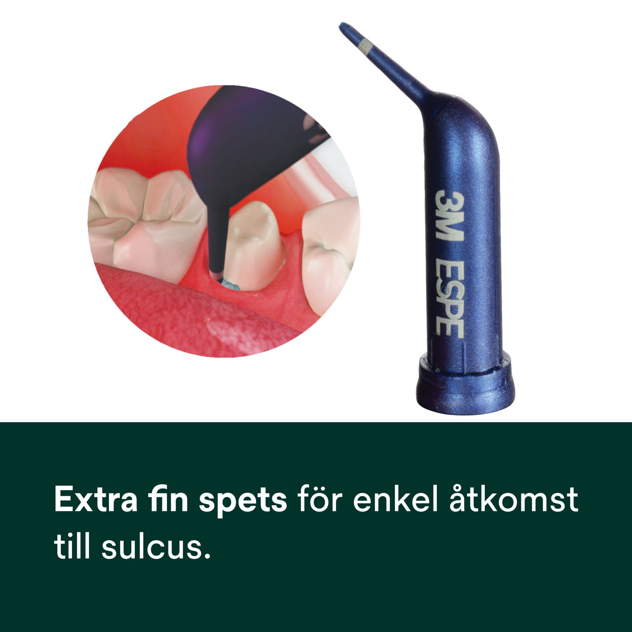 (2) Astringierende Retractionspaste: Extra fin spets