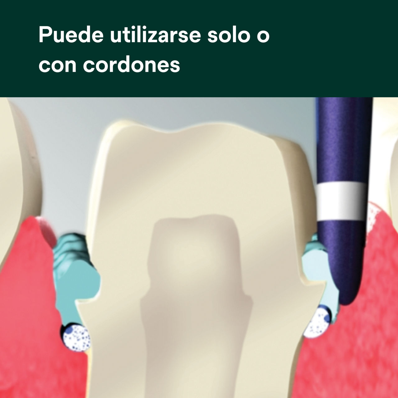 (4) Pasta de retracción astringente: Puede utilizarse solo o con hilos