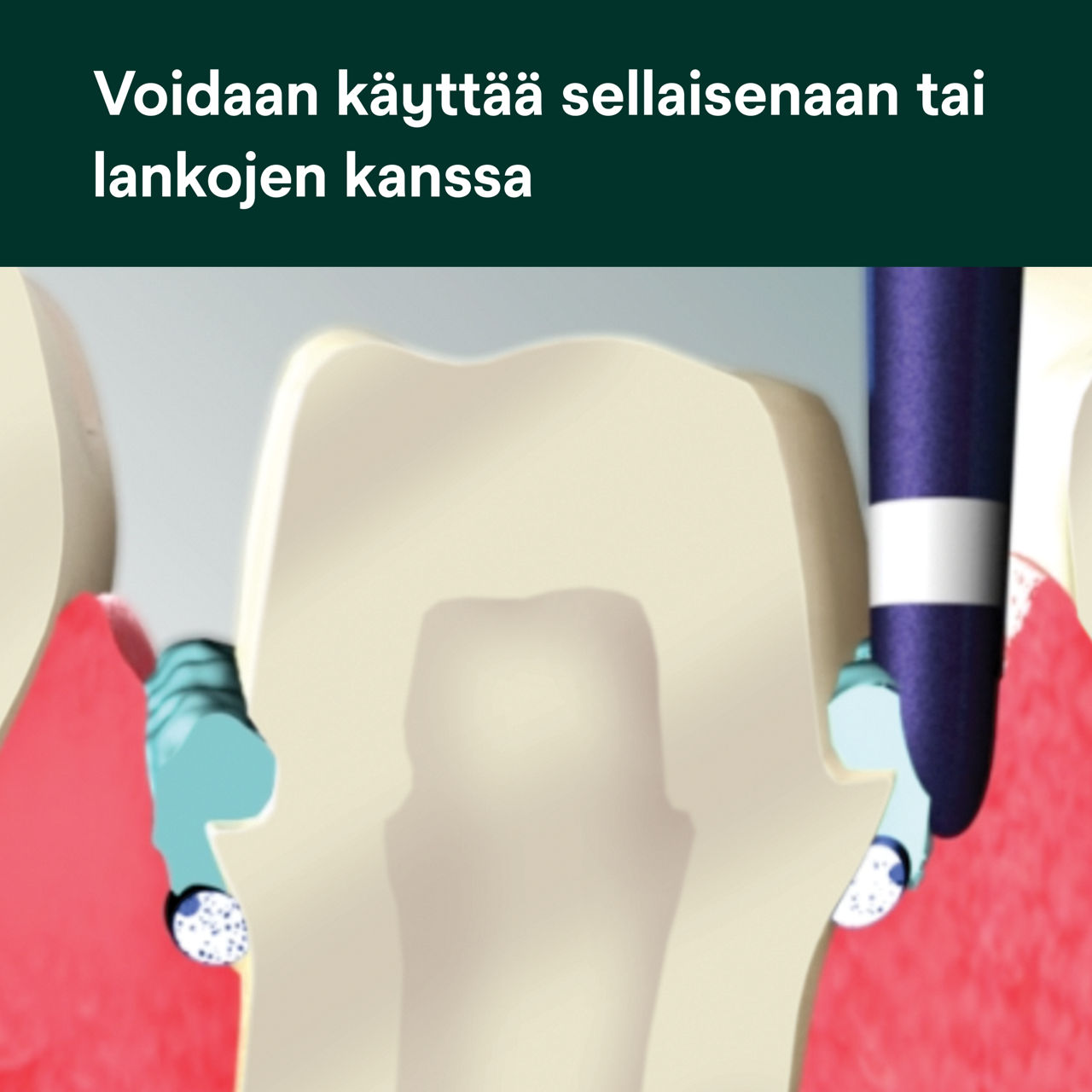 (4) Astringent retraktiopasta: Voidaan käyttää sellaisenaan tai lankojen kanssa