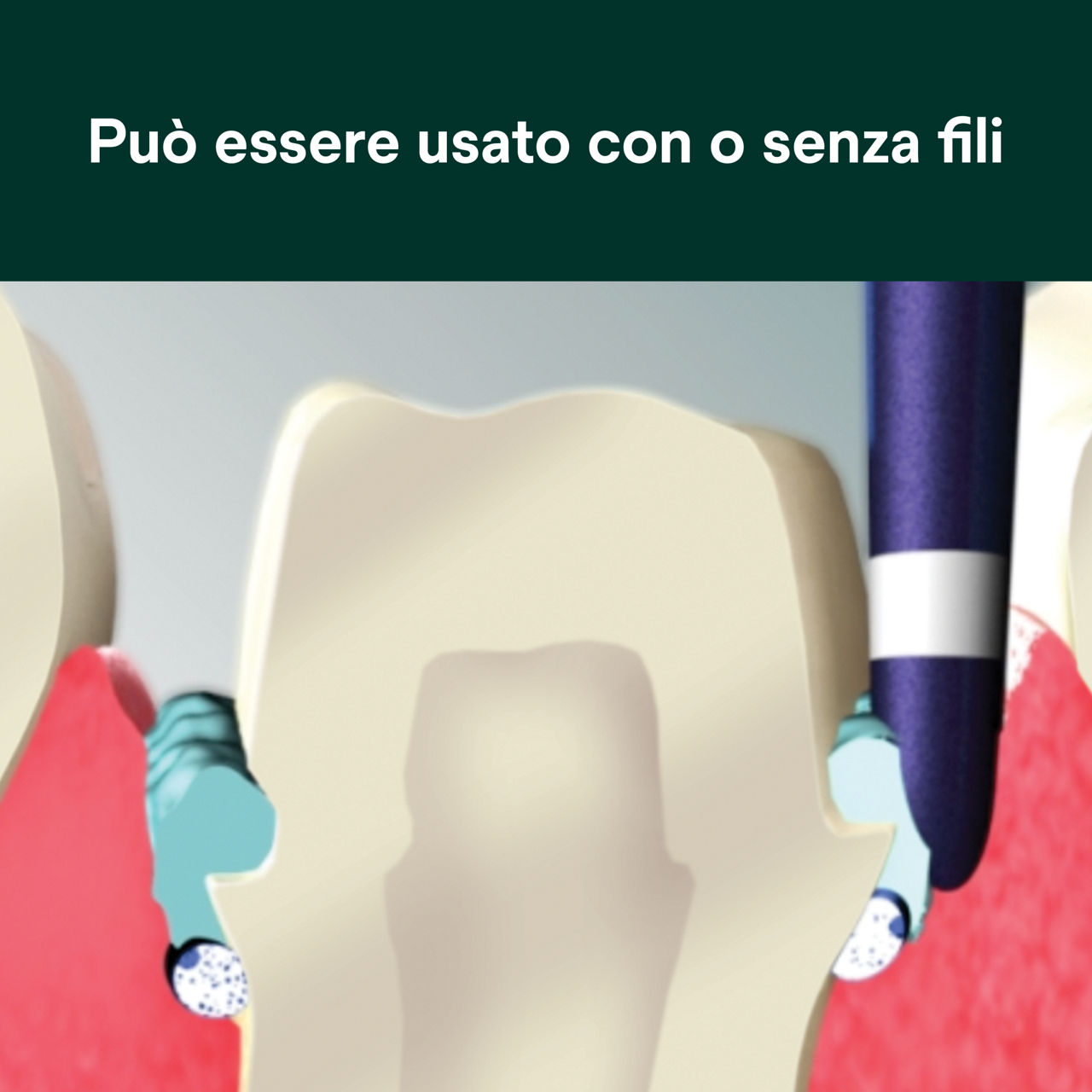 (4) Pasta di retrazione astringente: Può essere usato con o senza fili