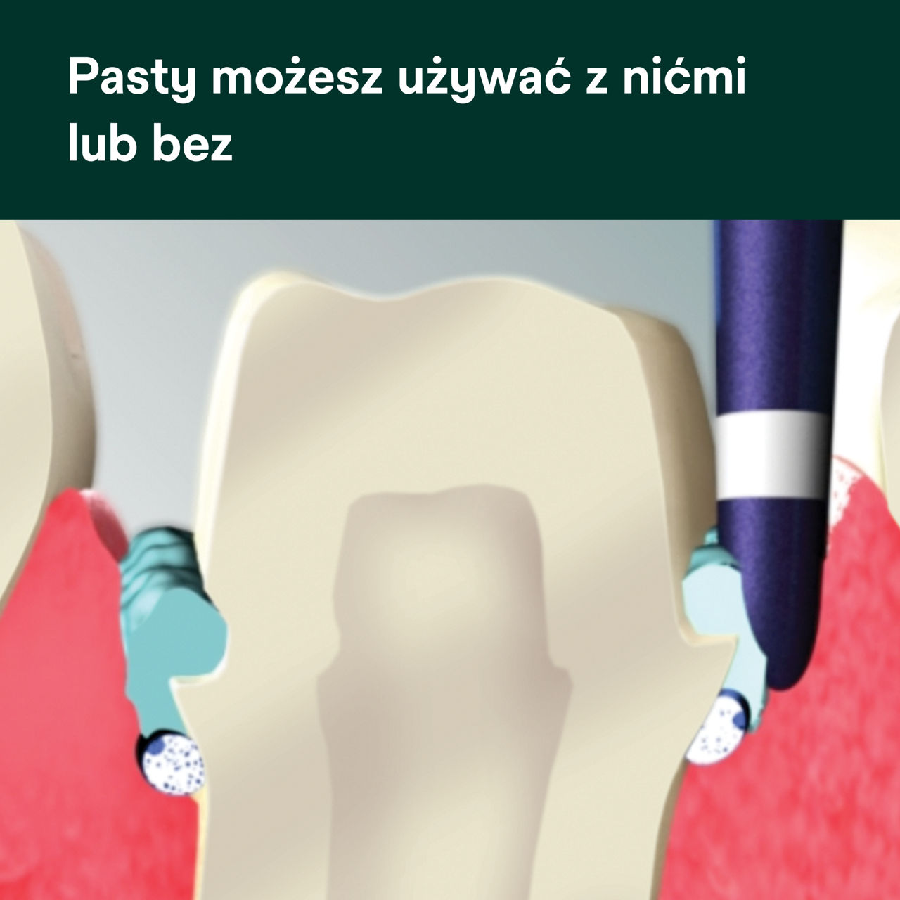 (4) Astringent - Pasta retrakcyjna: Pasty możesz używać z nićmi lub bez