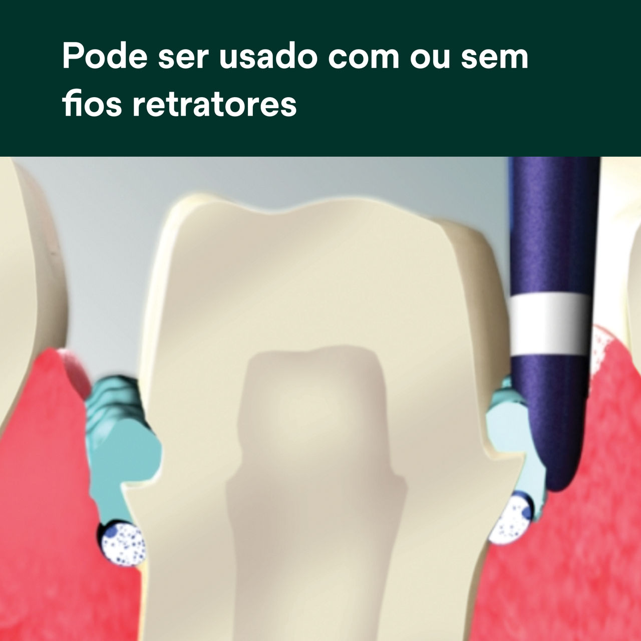 (4) Pasta Adstringente de Afastamento Gengival: Pode ser usada sozinha ou com fios retratores