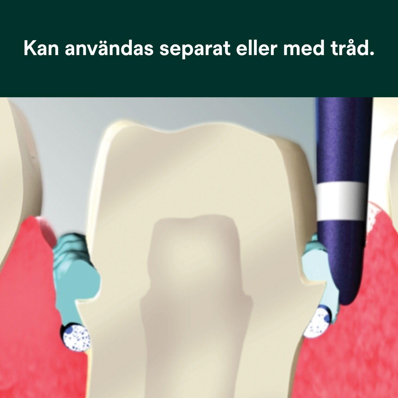 (4) Astringierende Retractionspaste: Kan användas separat eller med tråd