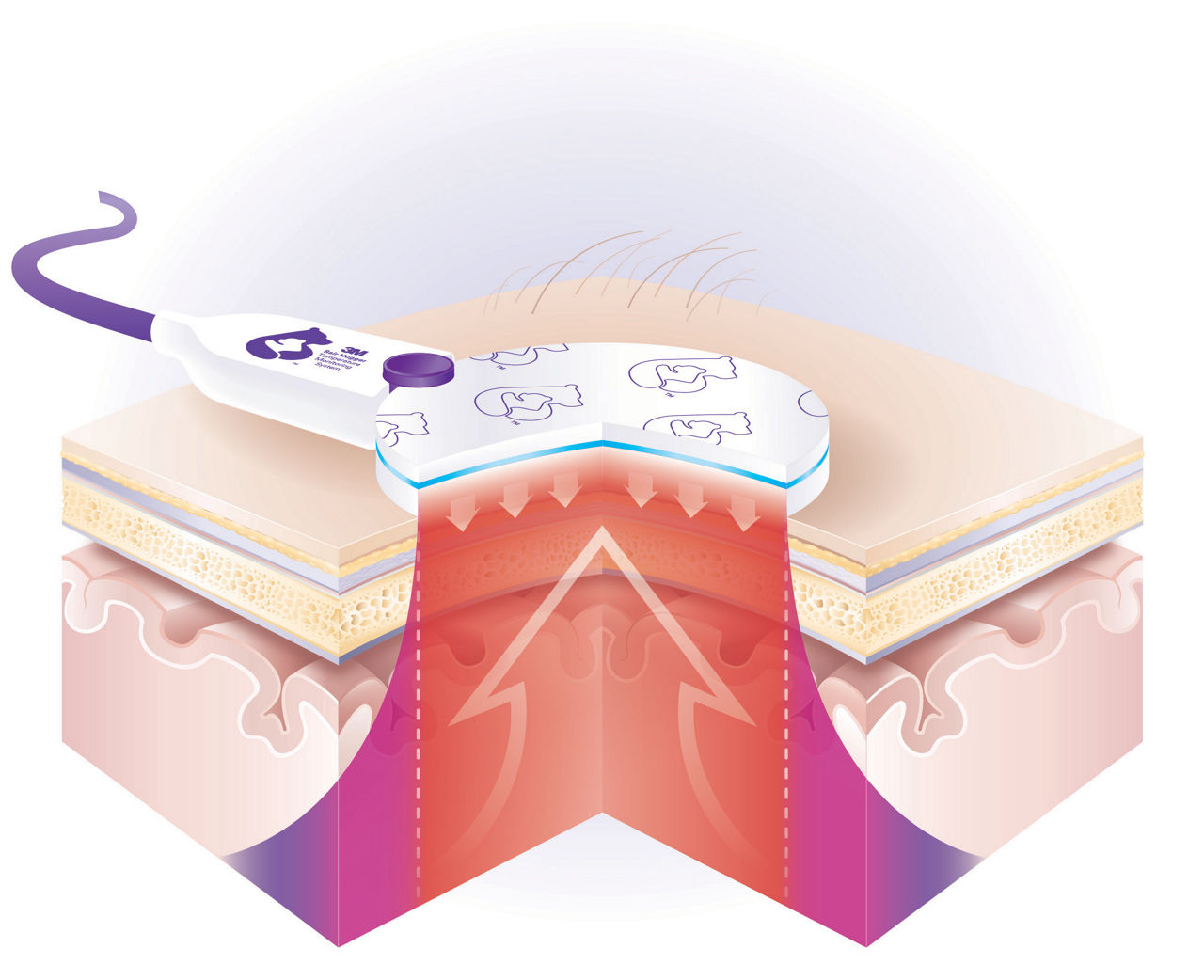 Formation of the isothermal pathway