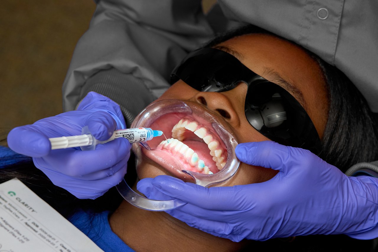 Breng het Unitek™ Etching Gel System of een ander etsmedium op basis van fosforzuur gedurende 15 seconden aan op de plaatsen waar de attachments worden bevestigd.