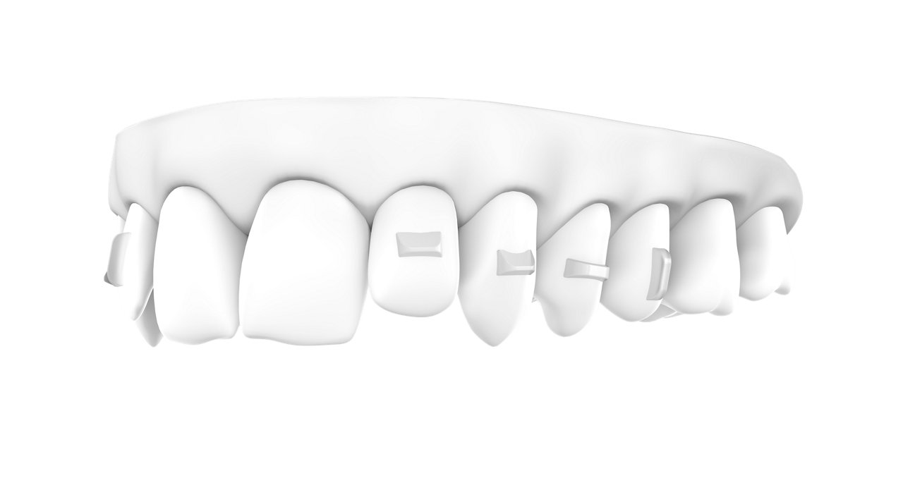 3D Rendering of Grip Aligners, focusing on Upper teeth with attachments