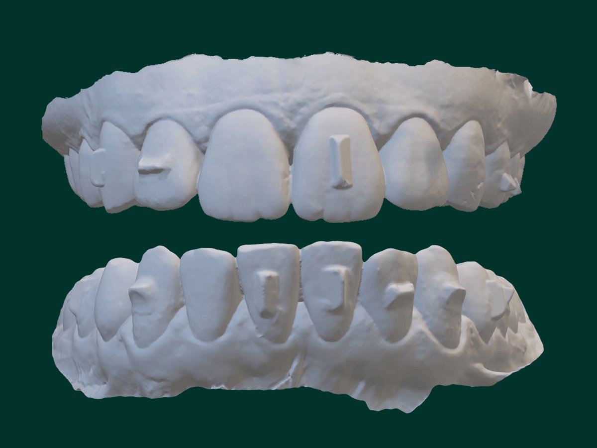 Front view of clarity grip clinical image