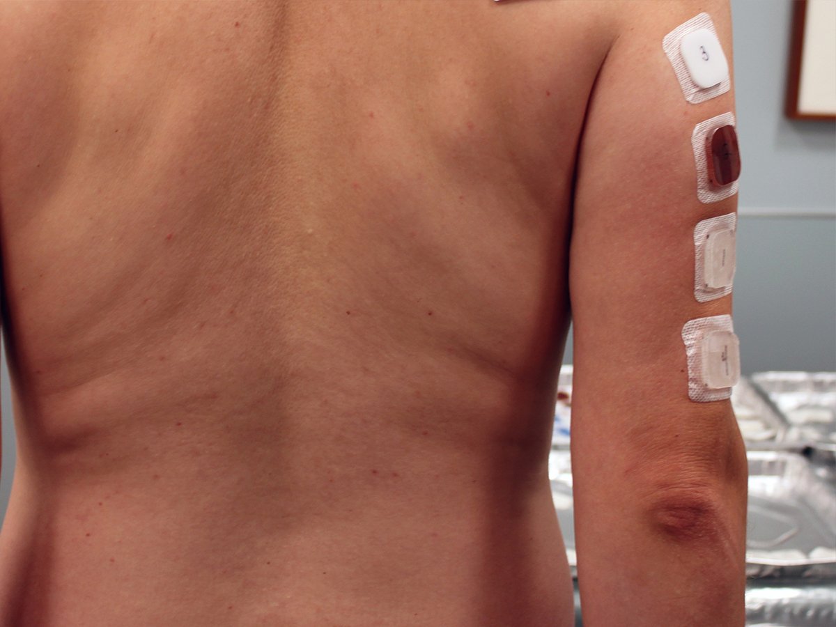 Medical Adhesives On Clinical Study Participant's Arms