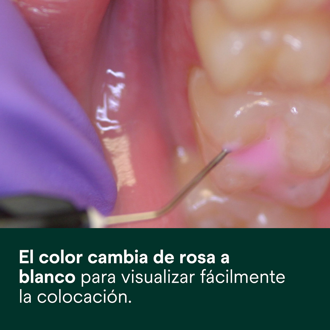 (2) Clinpro Sellante: Cambia de color de rosado a blanco para visualizar fácilmente la colocación.