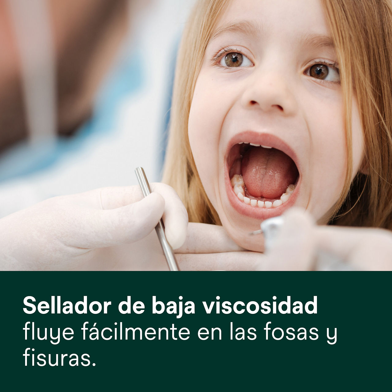 (4) Clinpro Sellante: El sellador de baja viscosidad fluye fácilmente en fosas y fisuras.