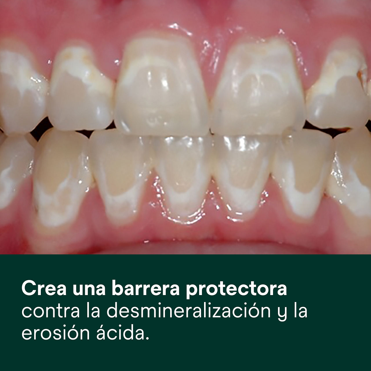 (2) Clinpro XT Barniz: Crea una barrera protectora contra la desmineralización y la erosión ácida.