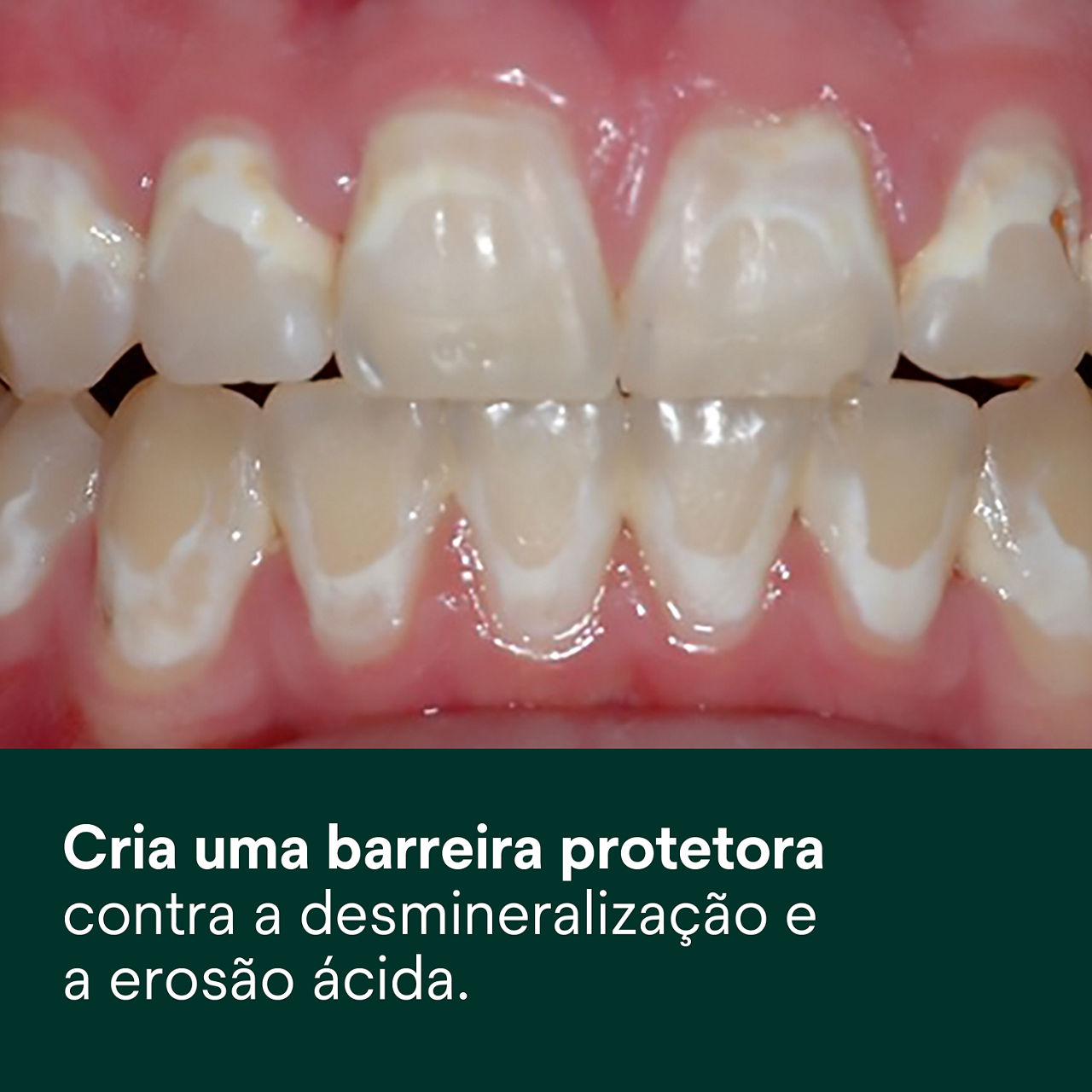 (2) Clinpro XT Verniz: cria uma barreira protetora contra a desmineralização e a erosão ácida