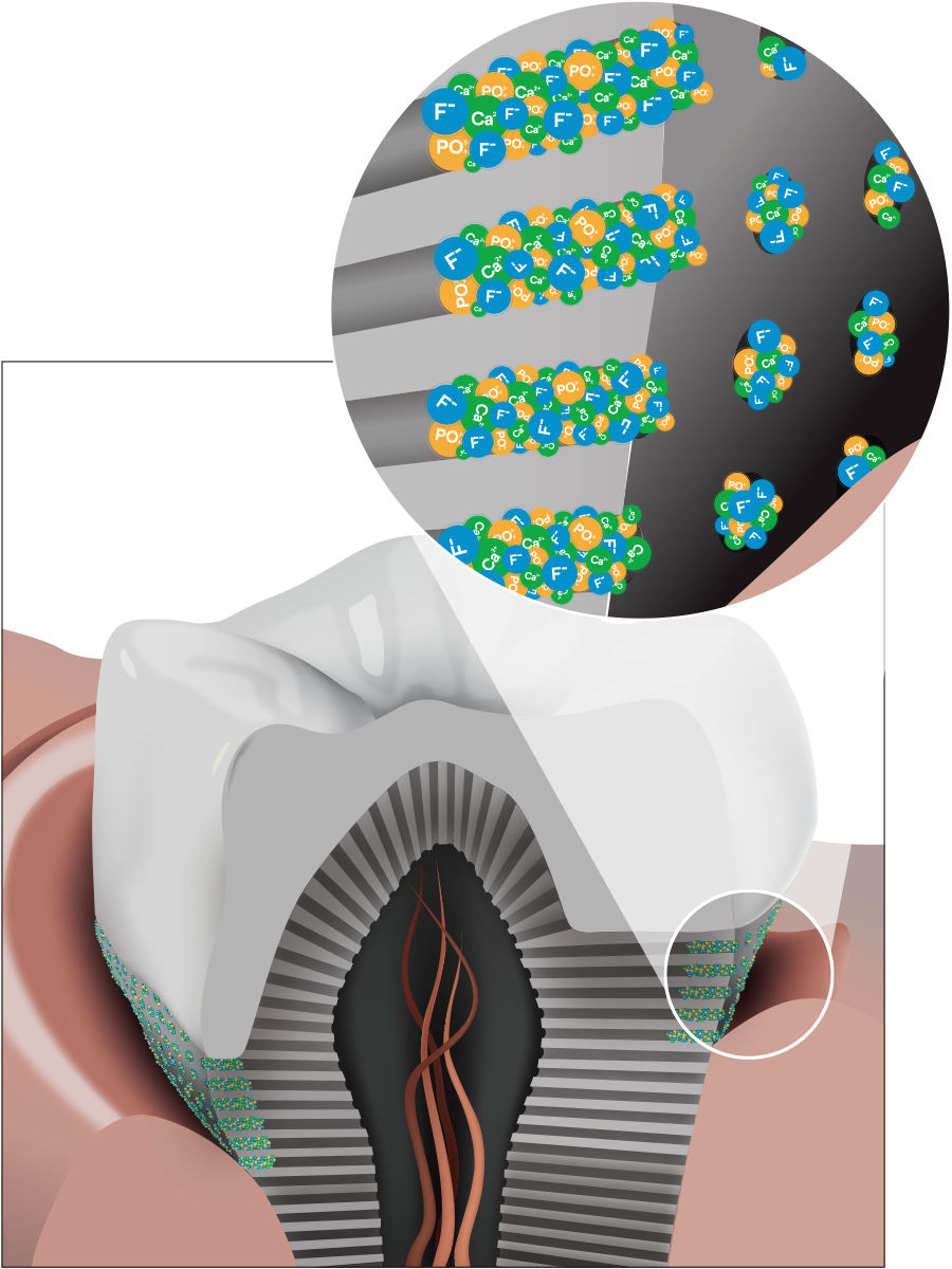 フッ化物で象牙細管をコーティングし知覚過敏を抑制
