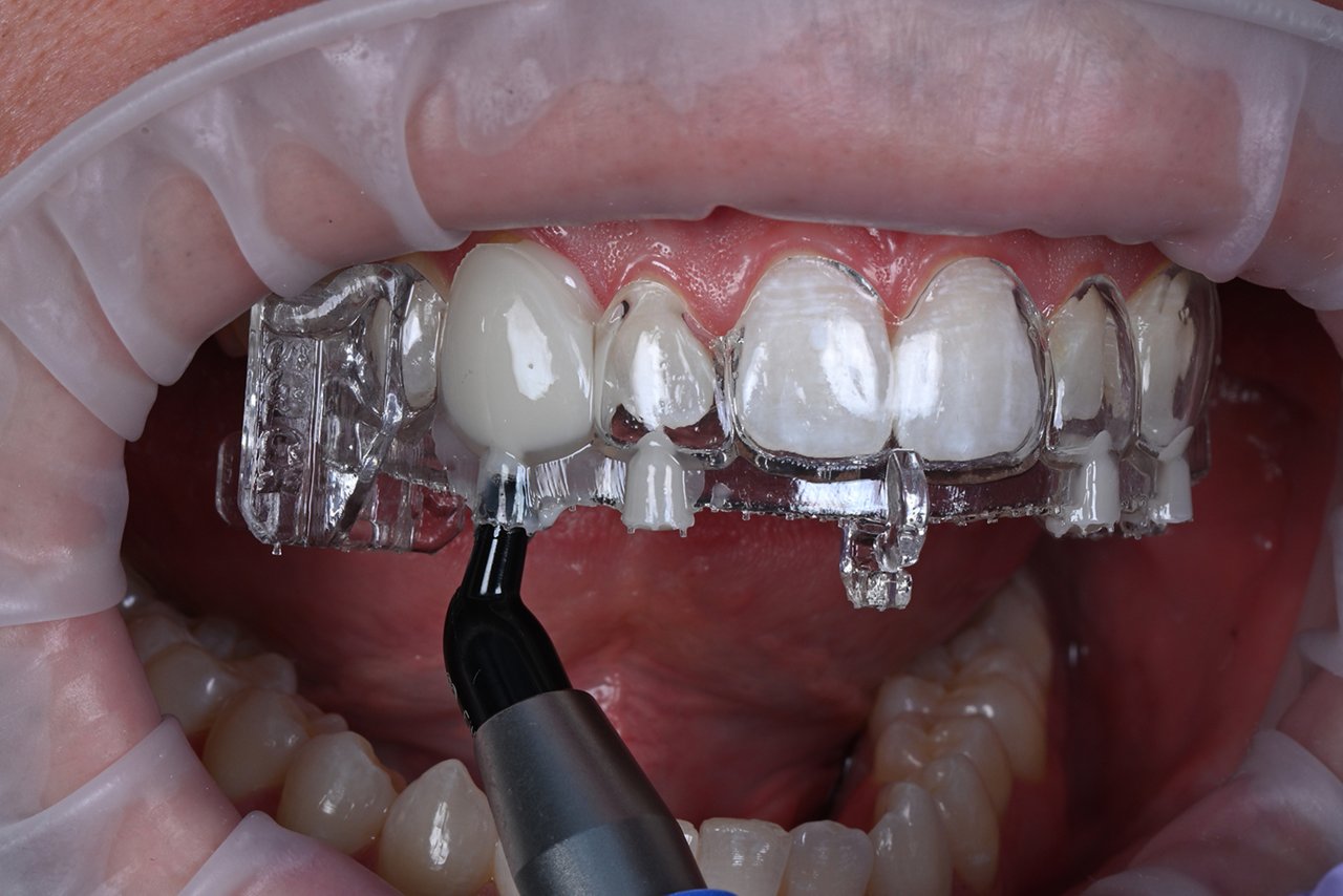 Injecting FSU, A capsule of FSU WB is then inserted into the reservoir. FSU is then injected to fill the veneering space.