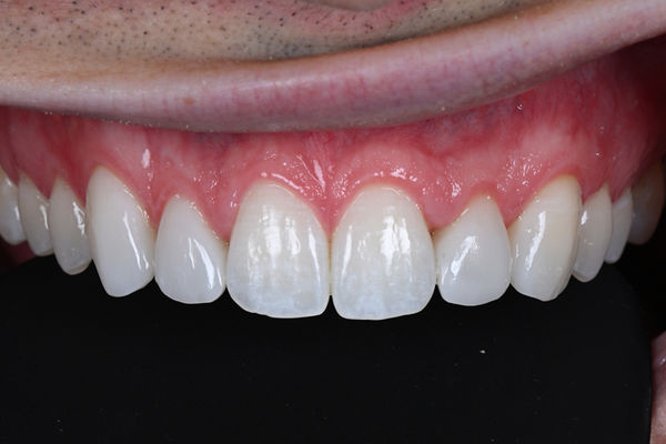 Retracted post op. Top row of teeth after anterior veneers procedure.