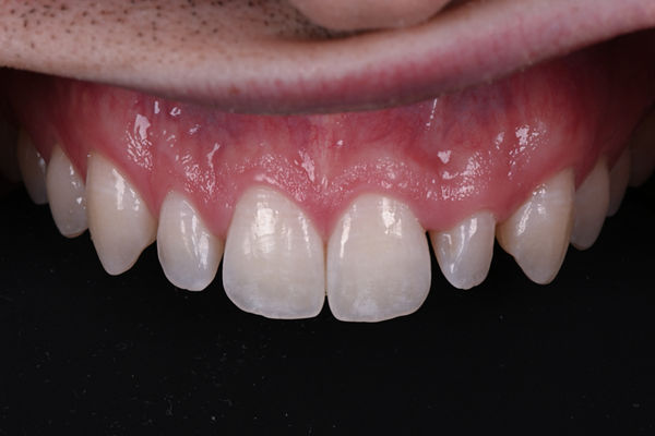 Retracted pre-op. Top row of teeth before anterior veneers procedure.