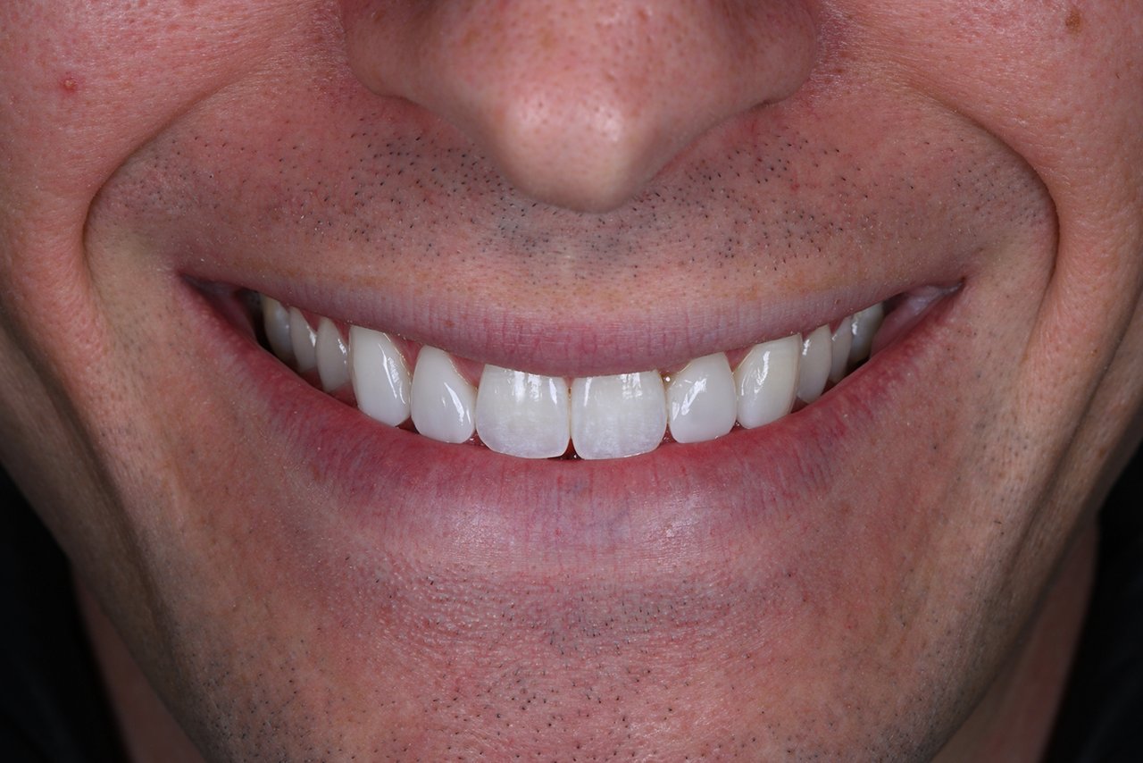 Final restoration. Four weeks later patient came back for a post op visit. Close-up of smiling mouth showing teeth.