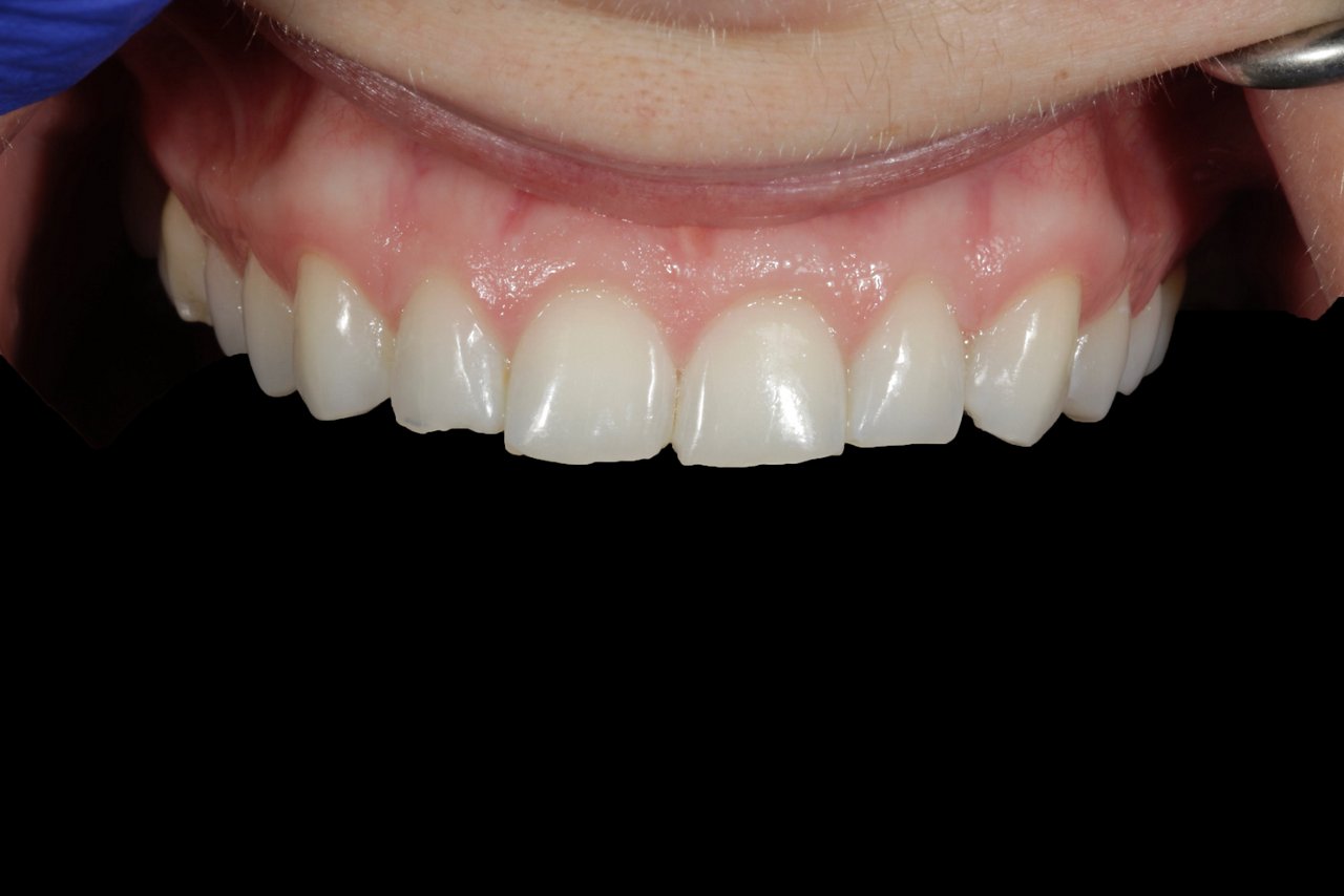 Close-up of mouth showing patient with worn anterior teeth following orthodontic treatment using Clarity Aligners.