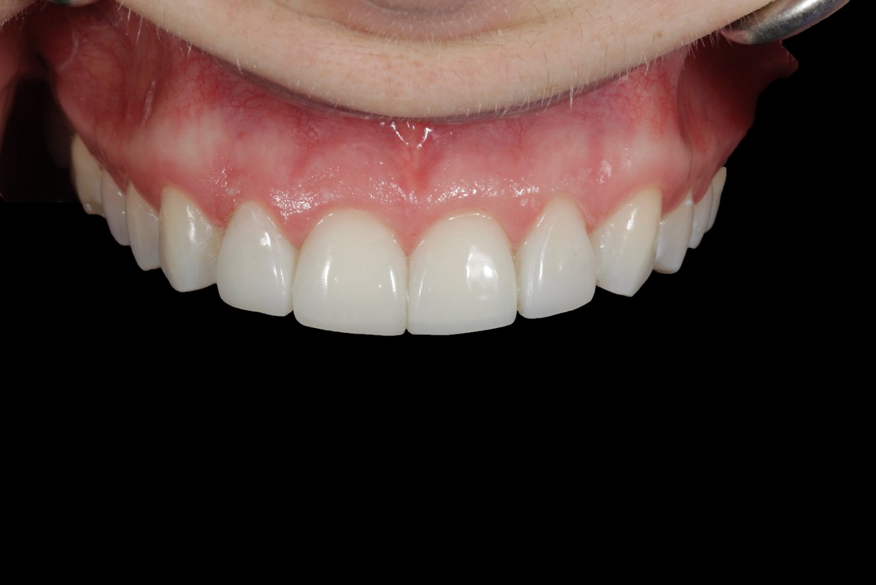 Close-up straight on view of mouth two week follow up after finishing and polishing completed.