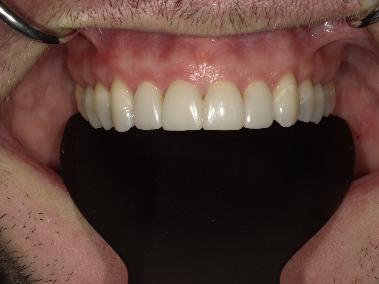 The clinical images from a next-generation Filtek Matrix case by Lois Duerst - Final Image 150