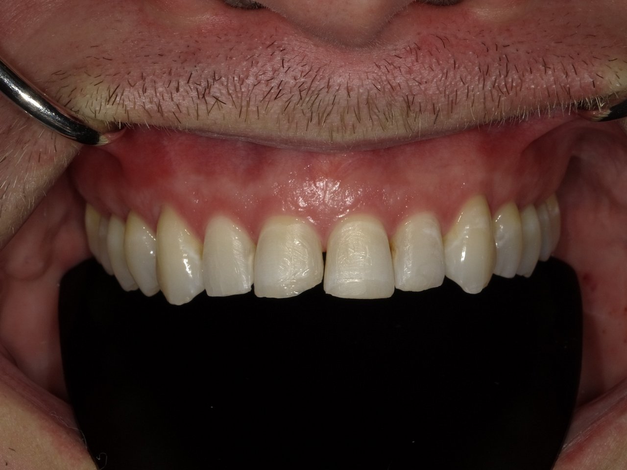 The clinical images from a next-generation Filtek Matrix case by Lois Duerst - Pre-Jetstream Image 19