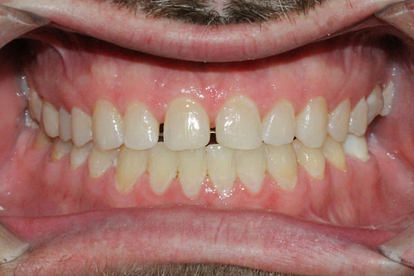 Clinical image for Post ortho diastema closure with cosmetic reshaping of anterior incisors from Stephen O. Shaw DDS. Retracted pre-op.