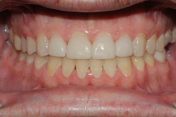 Clinical image for Post ortho diastema closure with cosmetic reshaping of anterior incisors from Stephen O. Shaw DDS. Final anatomy placed and polish protocol complete.