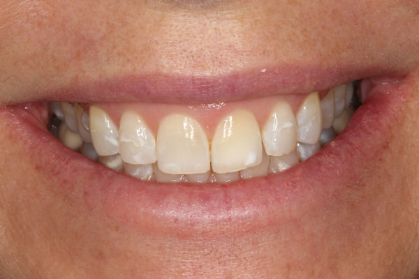 Preoperative, initial clinical image for Adam Hodges clinical case Conservative, Youthful Smile Makeover with Next-Generation Filtek Matrix. Incisal edge wear, hypomineralization and color change motivated this patient to desire conservative esthetic change.