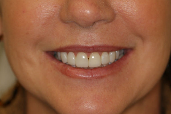 Two week follow-up of upper results clinical image for Adam Hodges clinical case Conservative, Youthful Smile Makeover with Next-Generation Filtek Matrix.