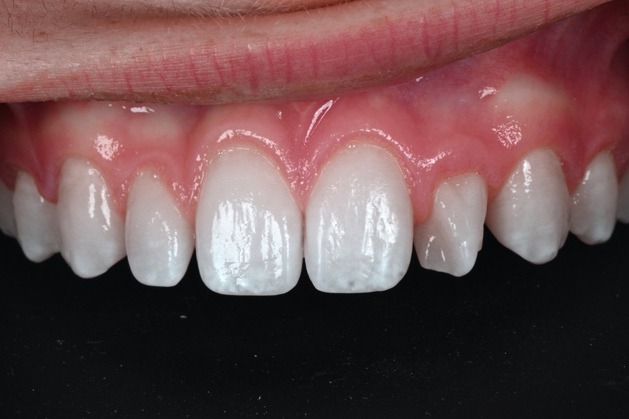 Retracted pre-op showing small laterals.