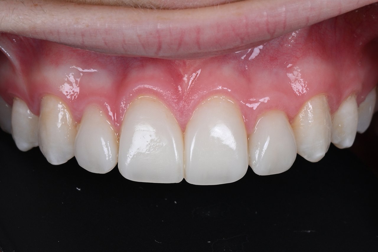 Retracted post op. Patient stated that he is very happy with his new smile.