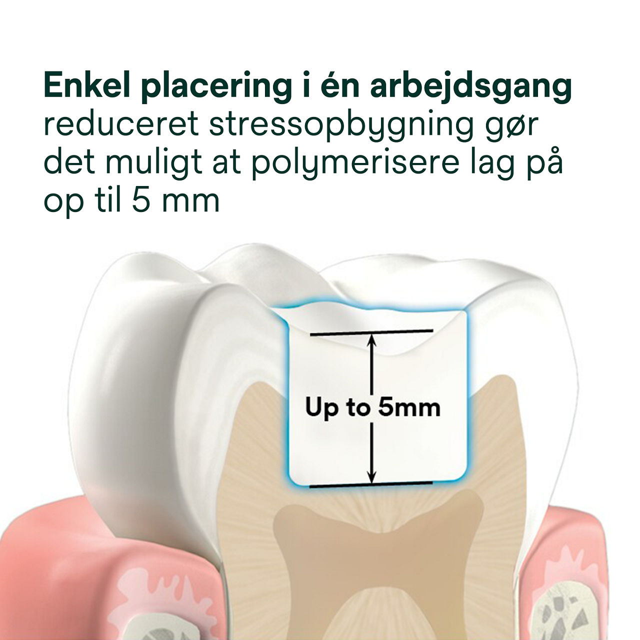 2- Filtek One Bulk Fill: Enkel placering i én arbejdsgang