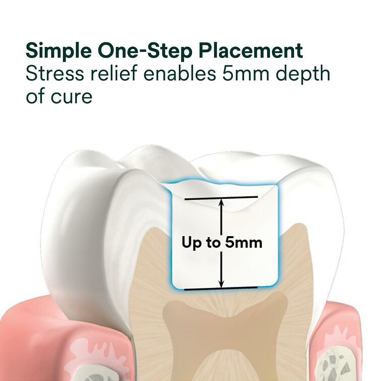 (2) 3M™ Filtek™ One Bulk Fill: Simple One-Step Placement