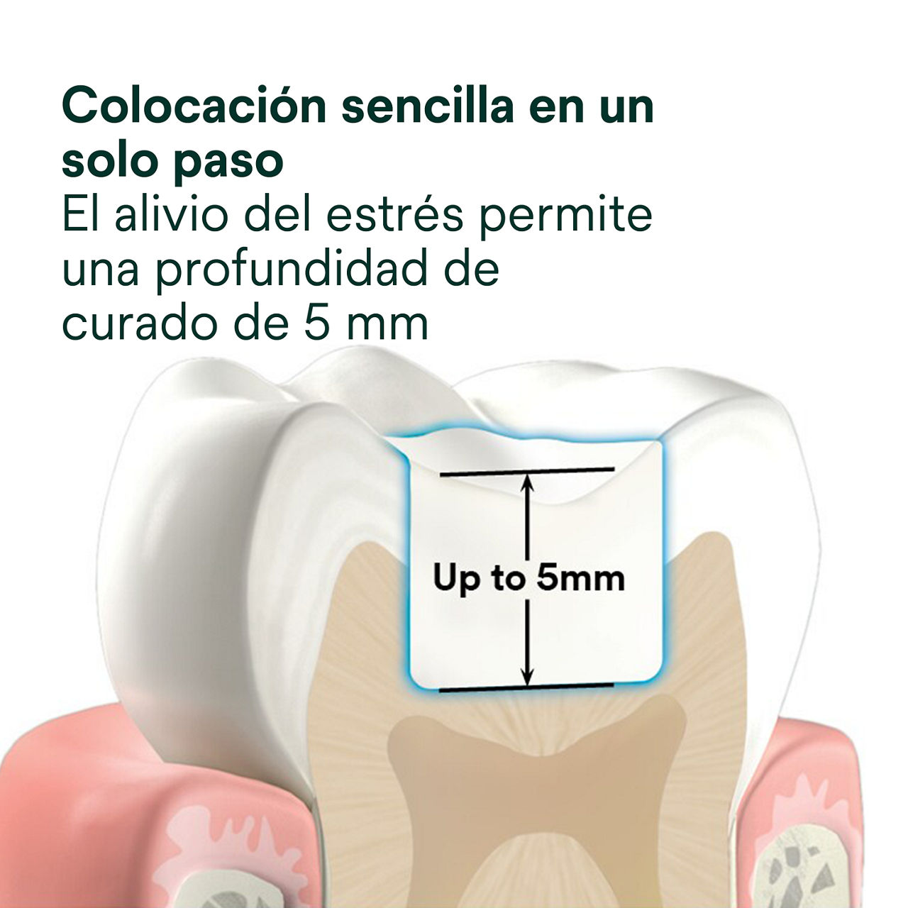 2- Filtek One Bulk Fill: Colocación sencilla en un solo paso