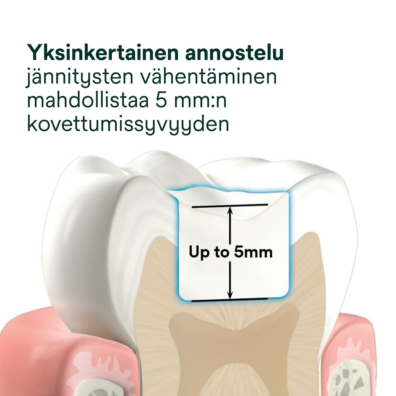 2- Filtek One Bulk Fill: Yksinkertainen annostelu