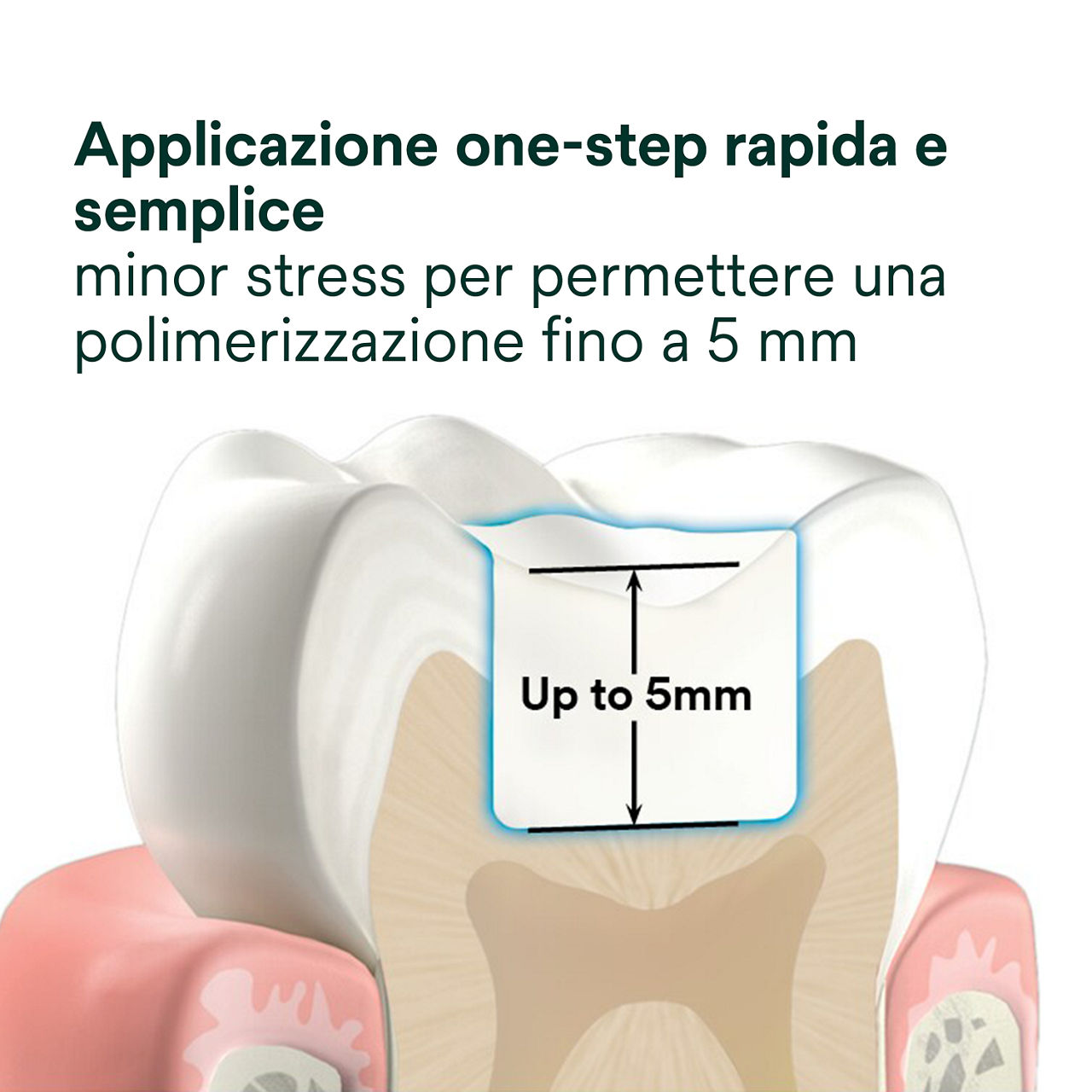 2- Filtek One Bulk Fill: Applicazione one-step rapida e semplice