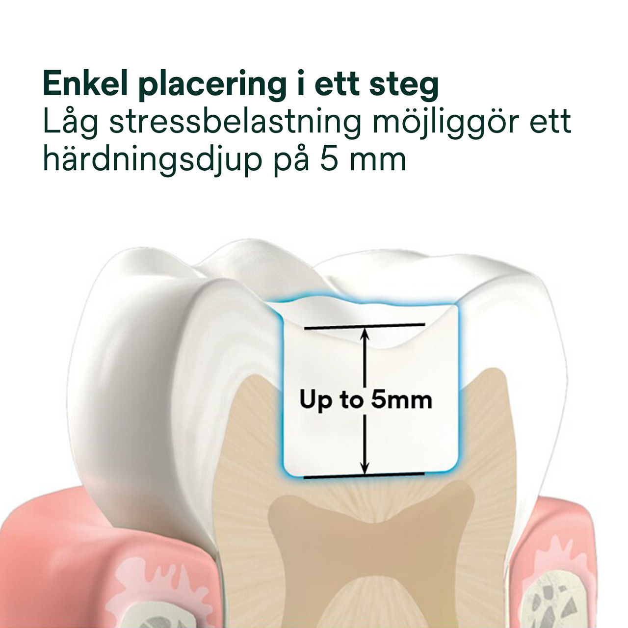 2- Filtek™ One Bulk Fill: Enkel placering i ett steg