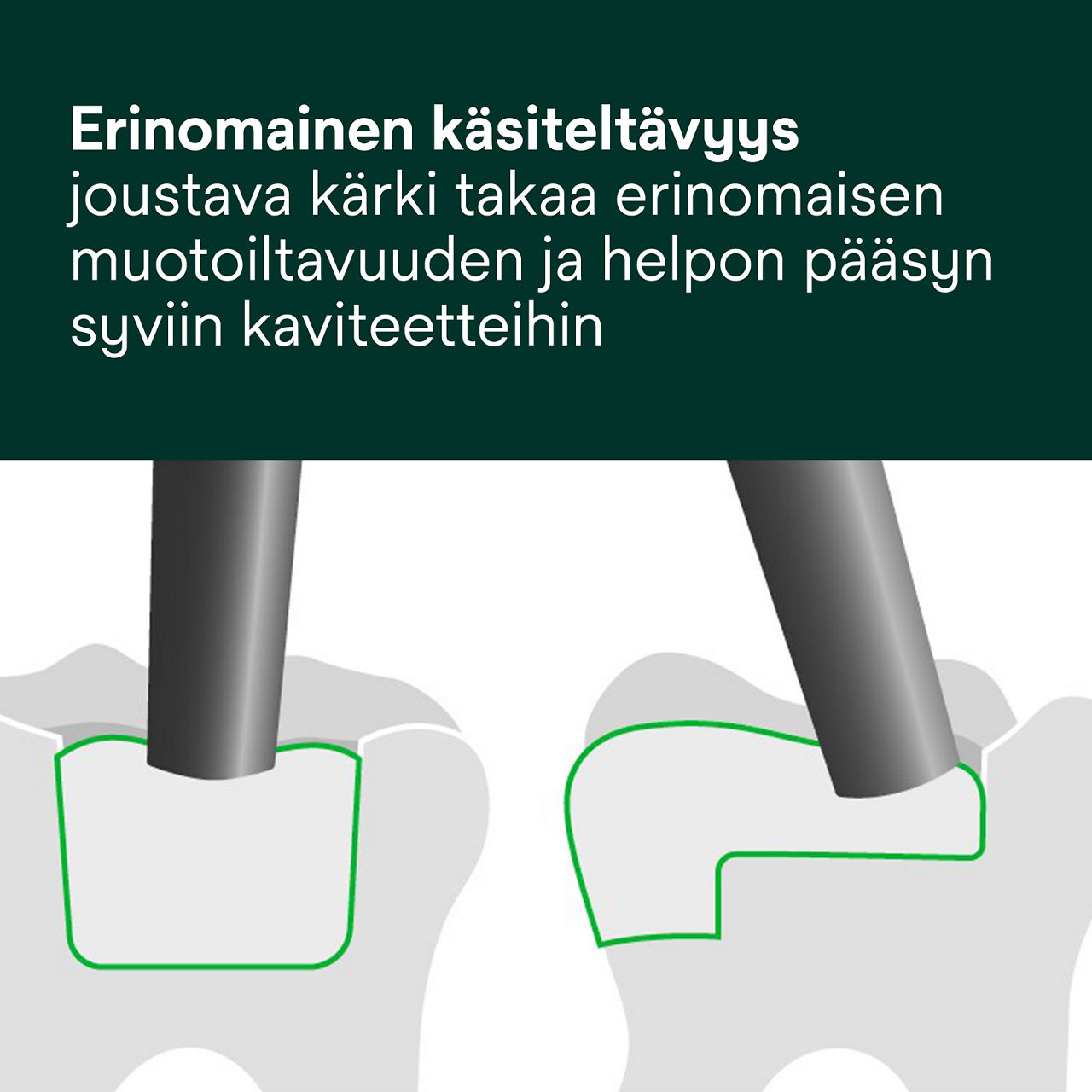 4- Filtek One Bulk Fill: Erinomainen käsiteltävyys