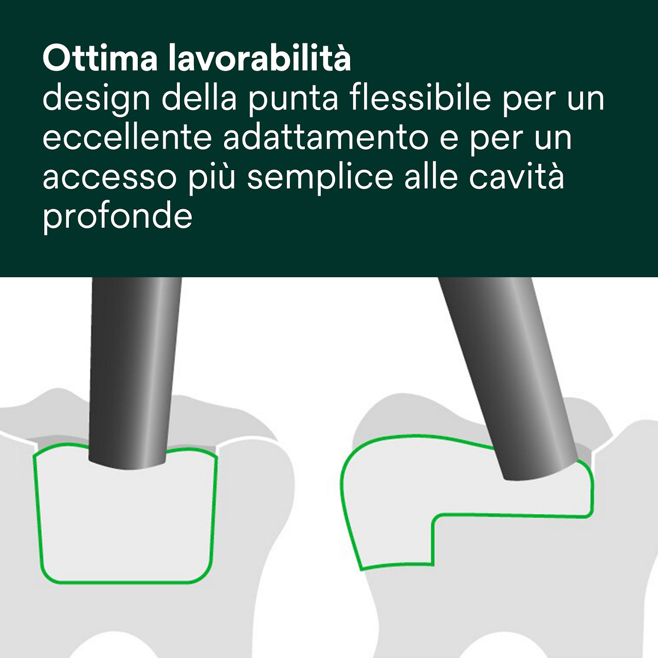 4- Filtek One Bulk Fill: Ottima lavorabilità