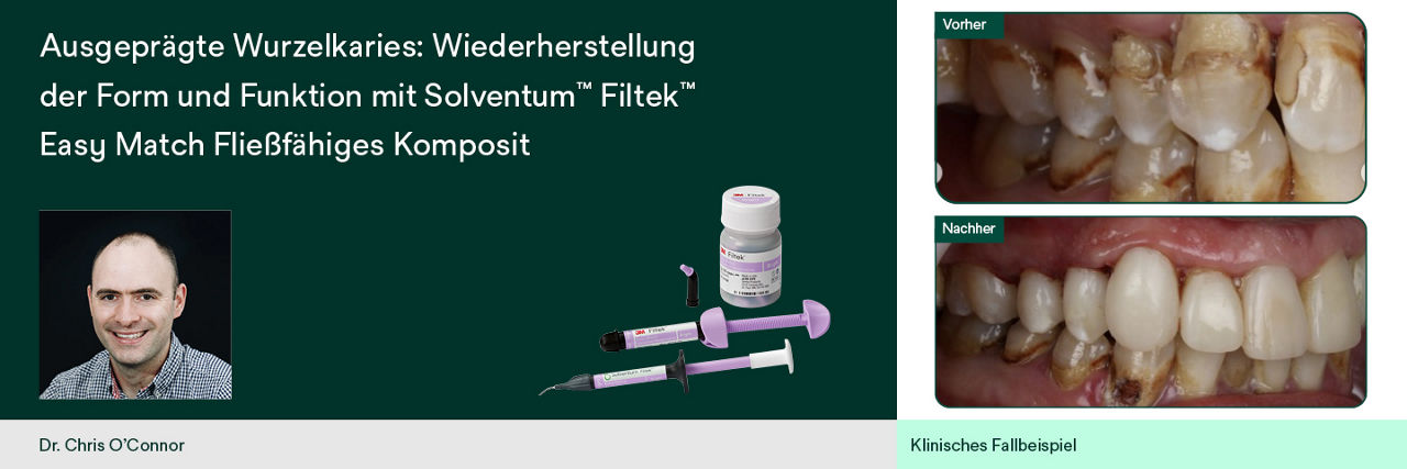 Restore form and function in extensive root caries with Solventum Filtek Easy Match Flowable Restorative
