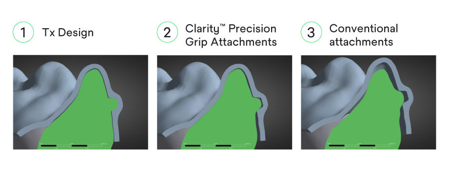 Aligner engagement comparison