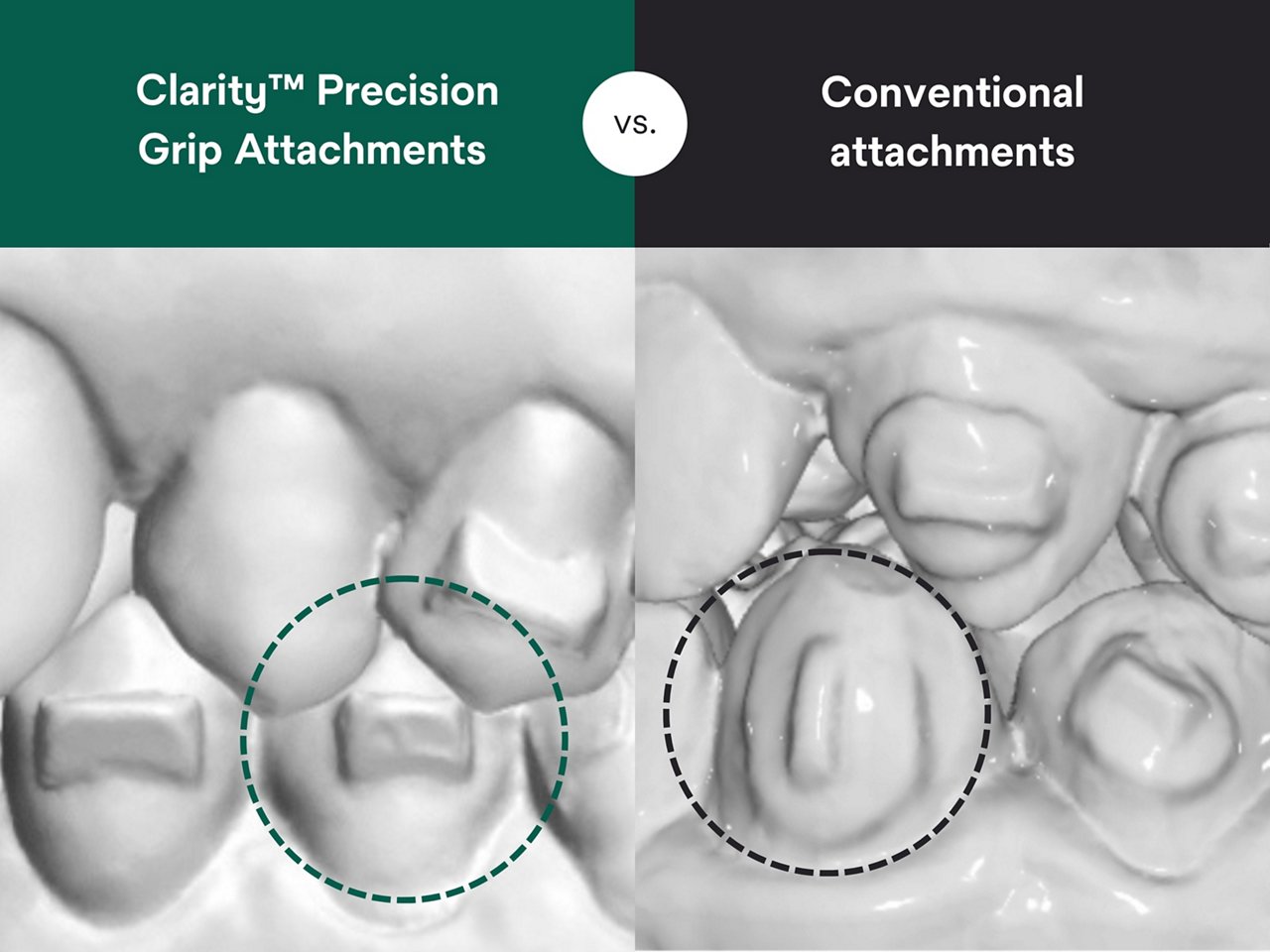 Split-screen comparison of precision grip dental attachments versus conventional attachments on tooth models; with dashed circles highlighting the attachment fit areas on each side.